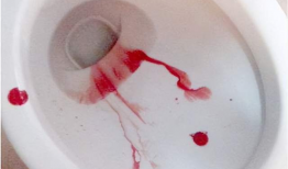 痔疮开刀全过程视频,直观了解开刀治疗过程