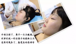 隆鼻视频全过程,隆鼻手术全过程解析